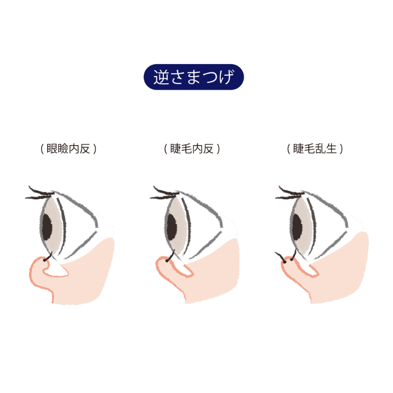 内反症