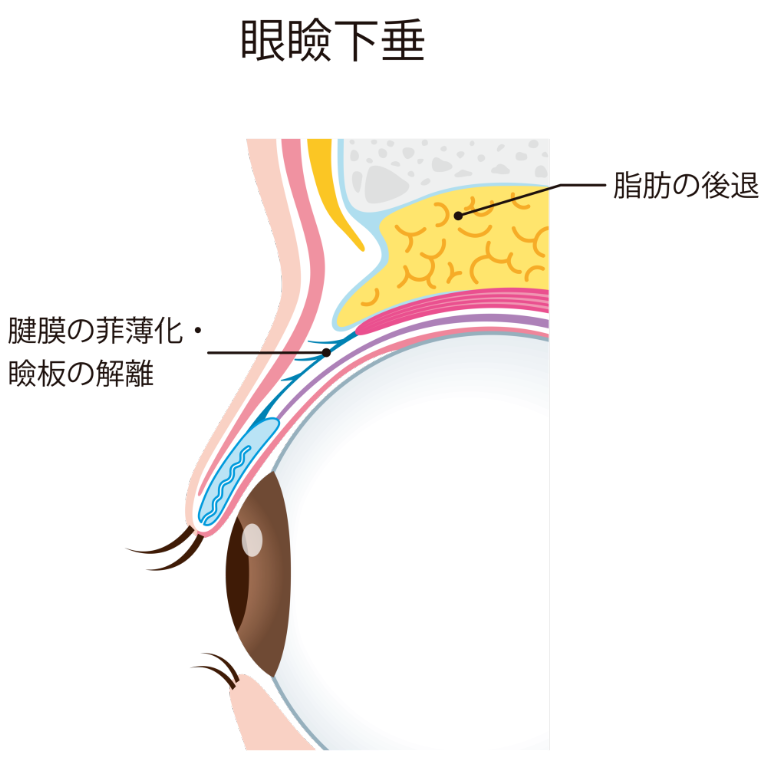 眼瞼下垂