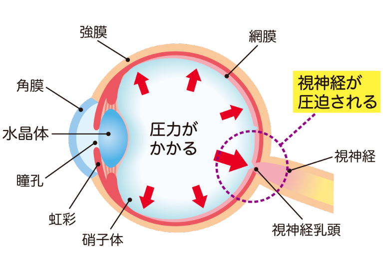 緑内障の原因