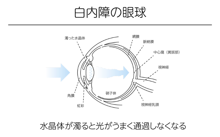 白内障とは
